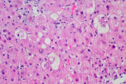 An&aacute;lisis de sangre de rutina podr&iacute;an ser clave para detener la cirrosis hep&aacute;tica