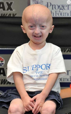 Consiguen corregir en ratones la progeria, un trastorno que causa envejecimiento acelerado