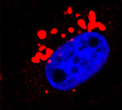 Dise&ntilde;an una estrategia que permite identificar dianas terap&eacute;uticas en c&aacute;ncer de mama triple negativo