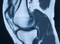 El reemplazo total de rodilla es rentable para pacientes con artrosis y pacientes con obesidad