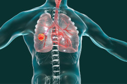 Experto asegura que cuando el c&aacute;ncer de pulm&oacute;n se diagnostica de forma m&aacute;s localizada la supervivencia llega al 55-60%
