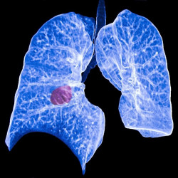 Identifican a los pacientes con c&aacute;ncer de pulm&oacute;n con m&aacute;s probabilidades de responder a la inmunoterapia