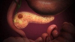 Identifican un nuevo biomarcador para el diagn&oacute;stico precoz del c&aacute;ncer de p&aacute;ncreas
