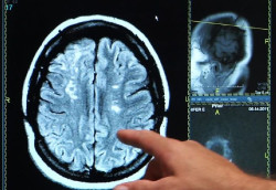 La trombosis venosa cerebral en pacientes Covid puede asociarse a una respuesta inmunitaria contra el virus