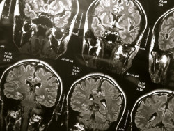 Los grandes espacios llenos de l&iacute;quido en el cerebro ayudar a identificar a las personas en riesgo de demencia