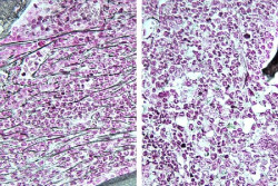 Un fármaco en fase de ensayo para el cáncer de mama también podría tratar algunos cánceres sanguíneos, según un estudio