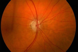 Un tipo de glaucoma, relacionado con un mayor riesgo de deterioro cognitivo